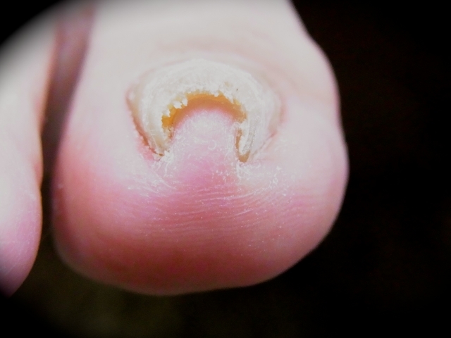 痛い巻き爪の原因は足の形 靴の圧迫 セルフケアで予防と対策を マイナビウーマン