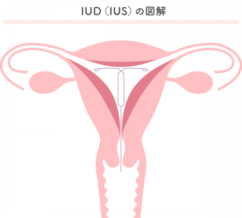 IUS（子宮内避妊システム）・IUD（子宮内避妊具）