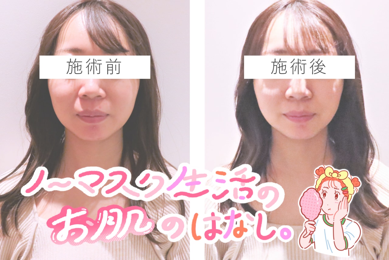 驚きの即効性。脱マスク時代に怯えるアラサー編集部員が美容施術